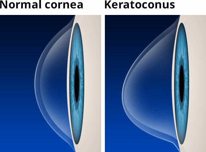 Keratoconus