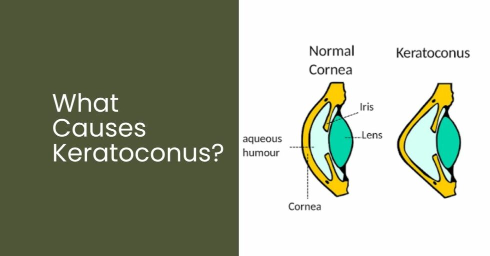 What Causes Keratoconus? Boneham Optometrist
